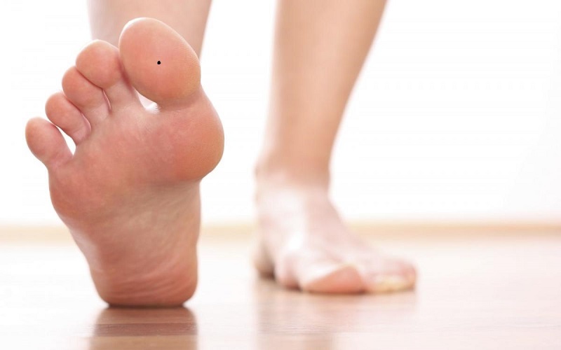 [Giải đáp] Nốt ruồi ở ngón chân cái có ý nghĩa gì?